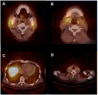 High clinical diagnostic accuracy of combined salivary gland and myocardial metaiodobenzylguanidine scintigraphy in the diagnosis of Parkinson’s disease